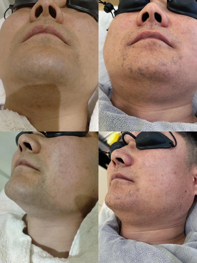 抖音刮脸变白那个是什么