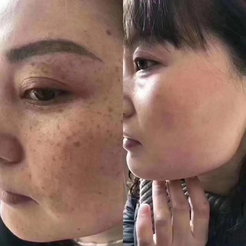 抖音上祛斑的是真的吗