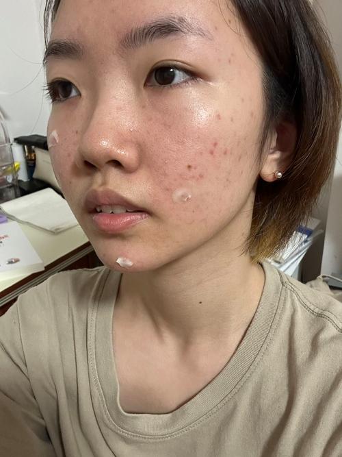 快手江苏女孩满脸痘痘