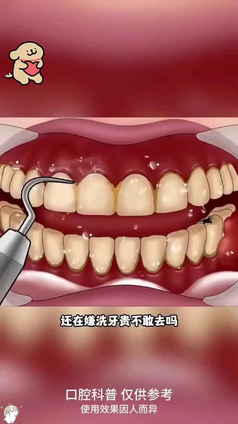 抖音上的洗牙的是什么