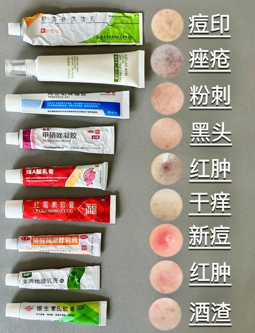 抖音上祛斑祛痘的药膏