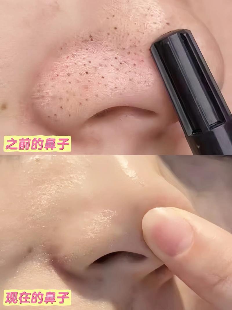 抖音去黑头撕拉面膜6