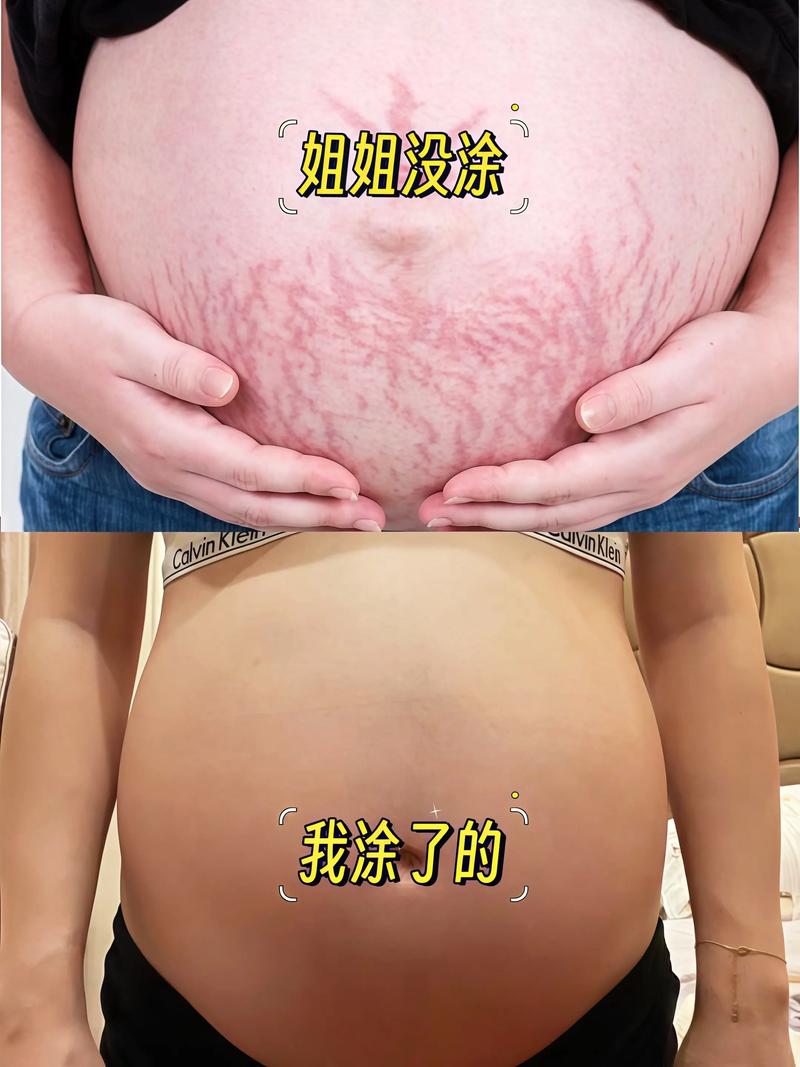 抖音上面祛妊辰纹的