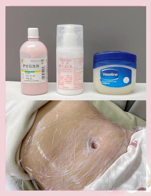 抖音上面祛妊辰纹的