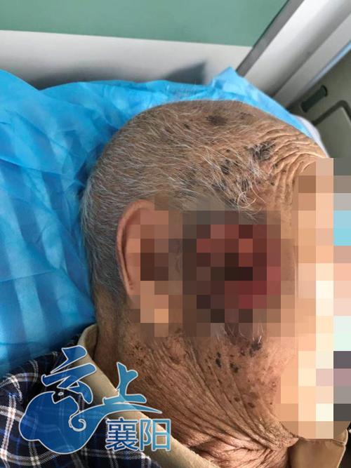 快手一个老人头上长蛆