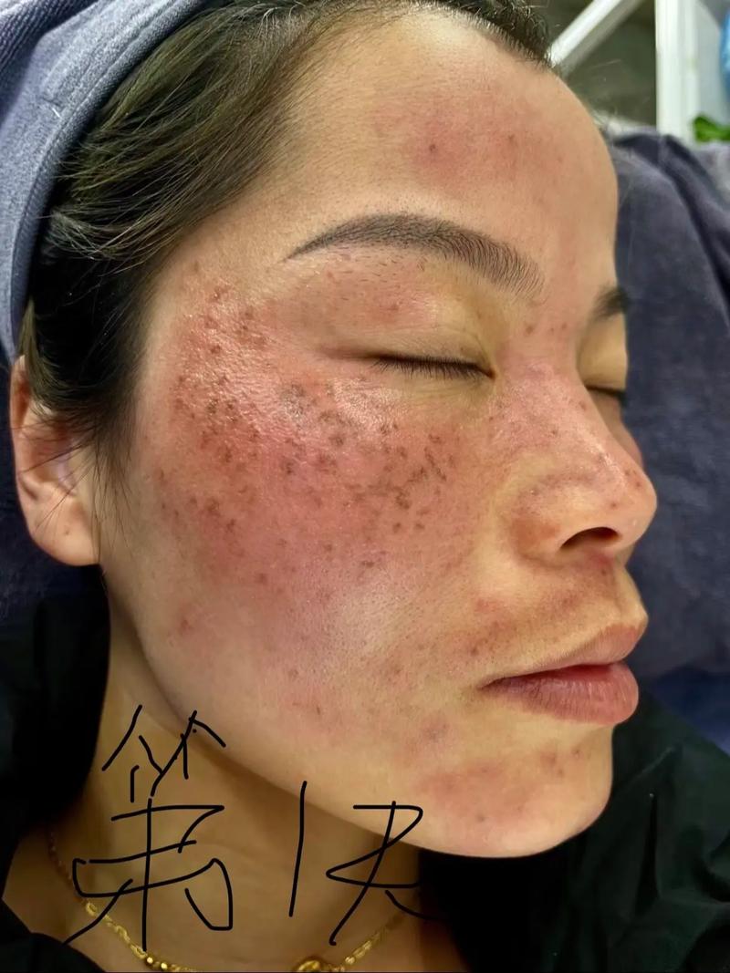 抖音上面的覆膜祛斑