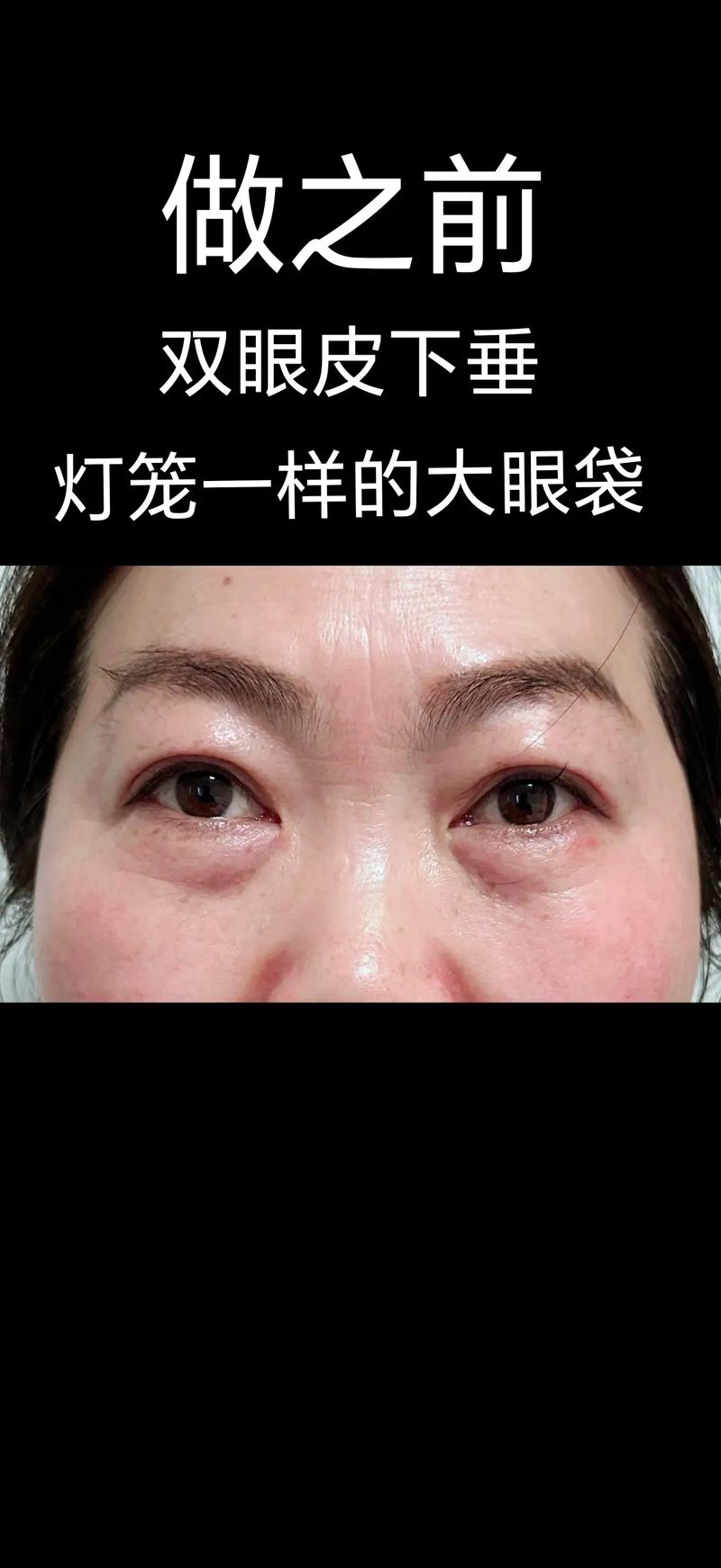 抖音黑色笔变双眼皮