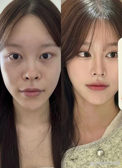 东方直播室赴韩整容