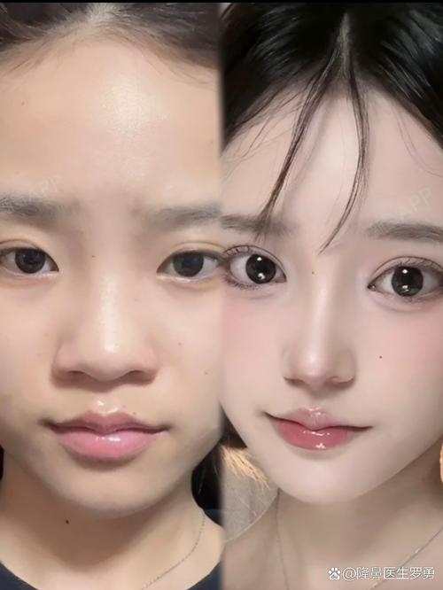 东方直播室赴韩整容