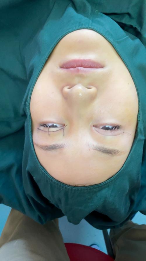 纳米双眼皮视频直播