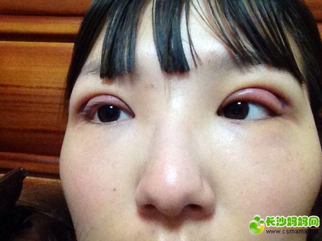 纳米双眼皮视频直播