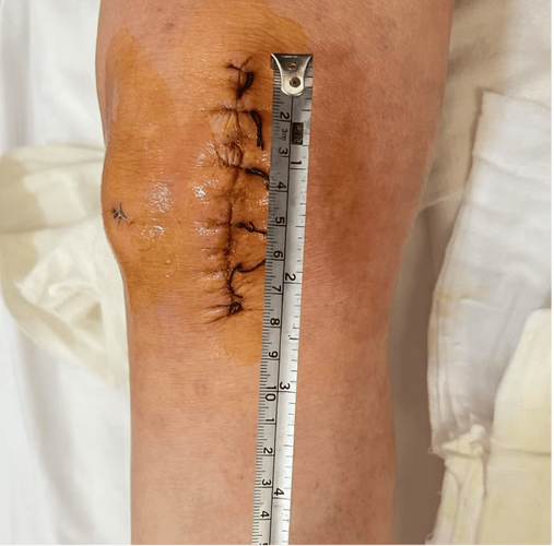 膝关节置换视频直播