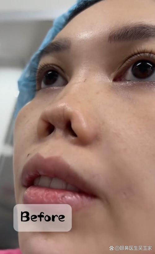 东方直播间整容失败