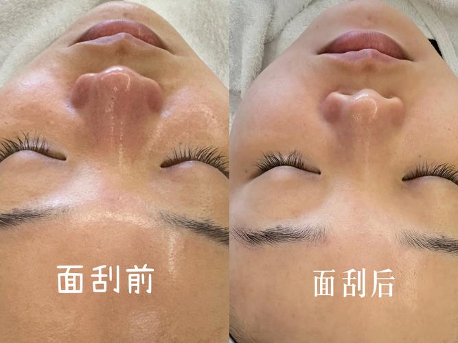 抖音小视频面部刮痧